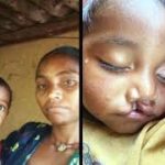 चिरायु योजना से जन्मजात समस्या से मिली राहत, तीन बच्चों के चेहरों पर लौटी मुस्कान